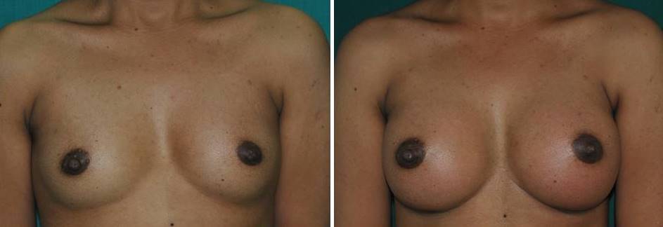 Result after breast implant surgery in Kerala